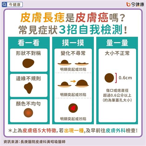 臉頰長痣|皮膚長痣是皮膚癌嗎？常見症狀，簡單3招自我檢測｜元氣